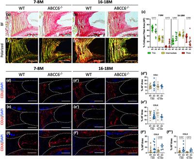 Abcc6 Null Mice—a Model for Mineralization Disorder PXE Shows Vertebral Osteopenia Without Enhanced Intervertebral Disc Calcification With Aging